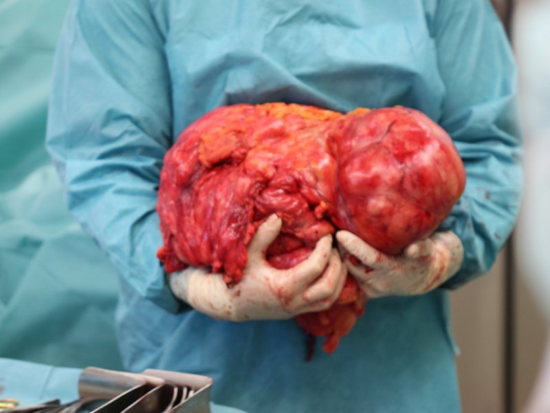 Tumor Monster 15 Kilo Altenburg